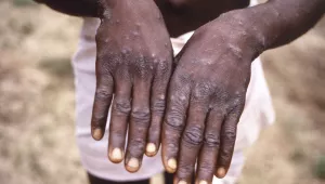 This 1997 image provided by the CDC during an investigation into an outbreak of monkeypox, which took place in the Democratic Republic of the Congo (DRC), formerly Zaire, and depicts the dorsal surfaces of the hands of a monkeypox case patient, who was displaying the appearance of the characteristic rash during its recuperative st