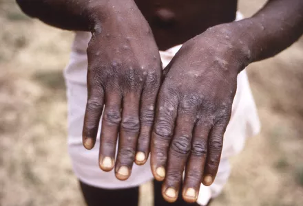 This 1997 image provided by the CDC during an investigation into an outbreak of monkeypox, which took place in the Democratic Republic of the Congo (DRC), formerly Zaire, and depicts the dorsal surfaces of the hands of a monkeypox case patient, who was displaying the appearance of the characteristic rash during its recuperative st